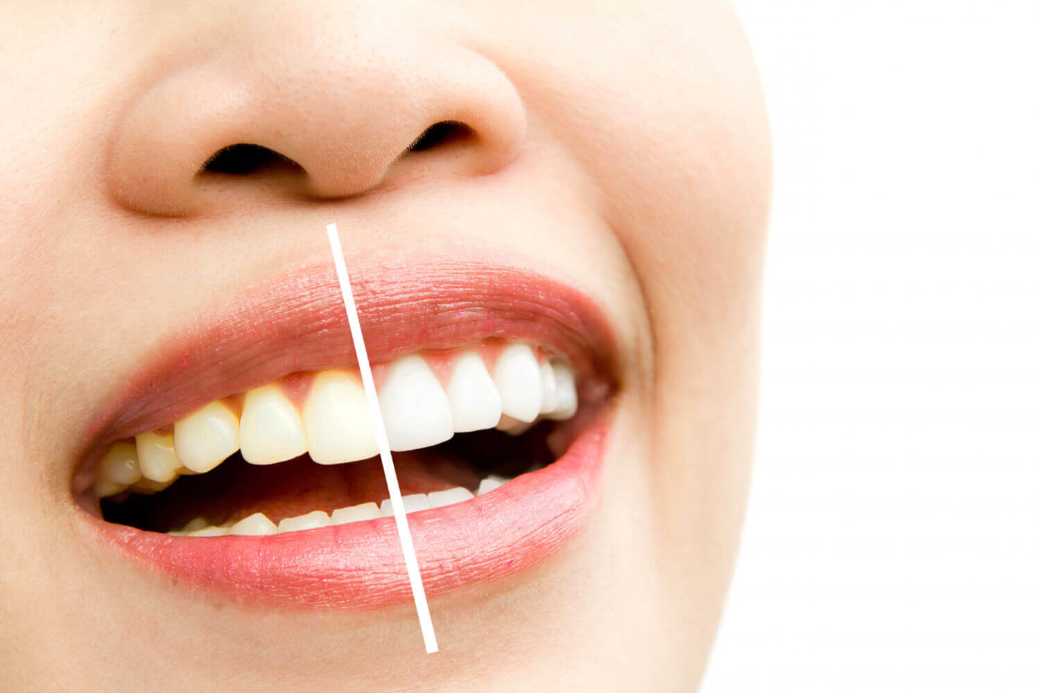 Sbiancamento denti